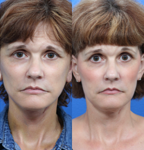 Facelift before and after photo