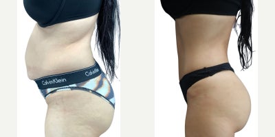 Liposuction before and after photo