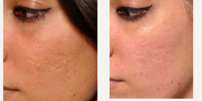 Microneedling before and after photo