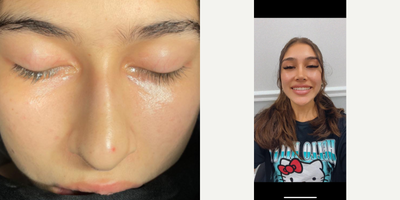 Rhinoplasty before and after photo