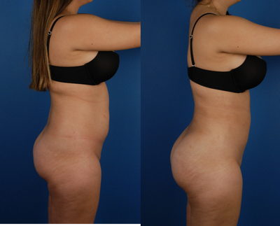 Brazilian Butt Lift before and after photo