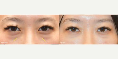Dermal Fillers before and after photo
