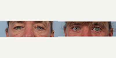 Eyelid Surgery before and after photo