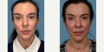 Sculptra before and after photo