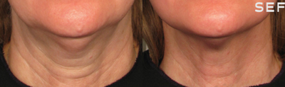Ultherapy before and after photo