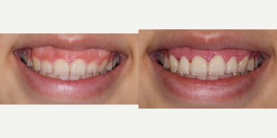 Gum Lift before and after photo