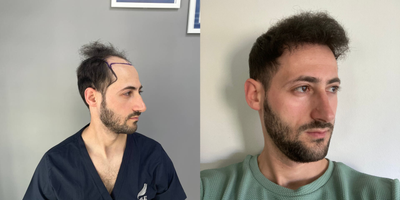 Hair Loss Treatment before and after photo