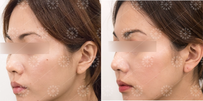 Ultherapy before and after photo