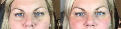 Volbella before and after photo