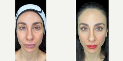 Eyelid Surgery before and after photo