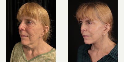 Neck Lift before and after photo