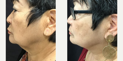 SculpSure before and after photo