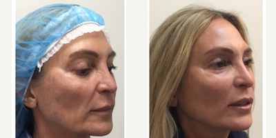 Skin Tightening before and after photo