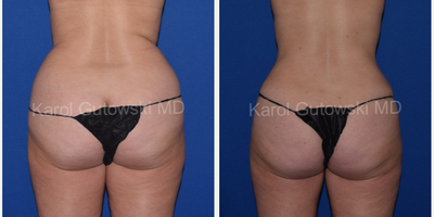 Brazilian Butt Lift before and after photo