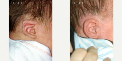 Ear Surgery before and after photo