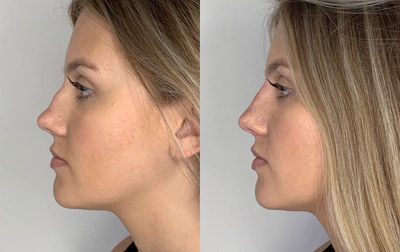 Juvederm before and after photo