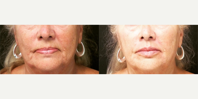 Juvederm before and after photo
