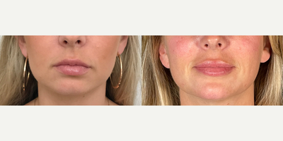 Lip Fillers before and after photo
