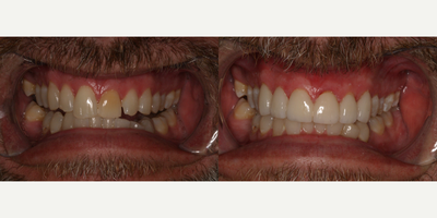Porcelain Veneers before and after photo