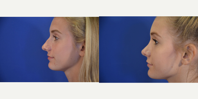 Rhinoplasty before and after photo