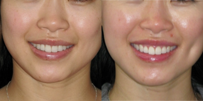 Dimple Surgery before and after photo
