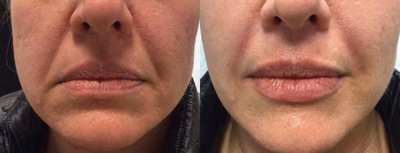 Juvederm before and after photo