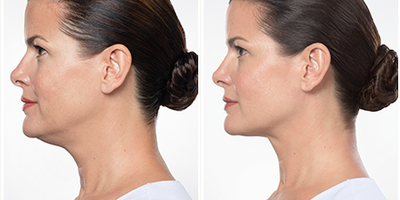 Kybella before and after photo