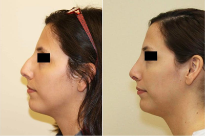 Rhinoplasty before and after photo