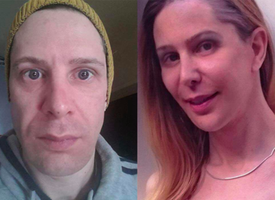 Transgender Facial Feminization Surgery before and after photo