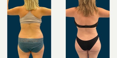 Tummy Tuck before and after photo