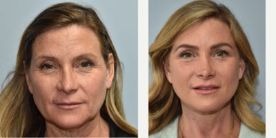 CO2 Laser before and after photo