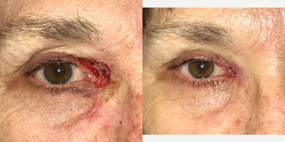 Mohs Surgery before and after photo