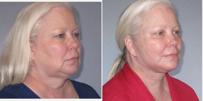 Neck Lift before and after photo