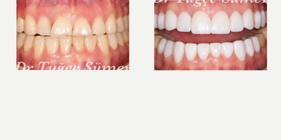 Porcelain Veneers before and after photo