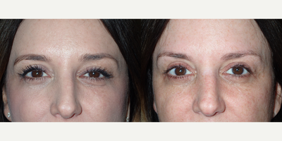 Ptosis Surgery before and after photo