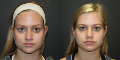 Rhinoplasty before and after photo