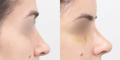 Rhinoplasty before and after photo