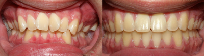 Smile Makeover before and after photo