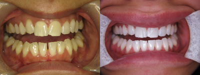 Teeth Whitening before and after photo