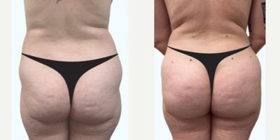 Brazilian Butt Lift before and after photo