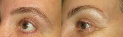 Brow Lift before and after photo