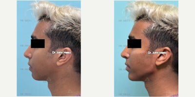 Chin Filler before and after photo