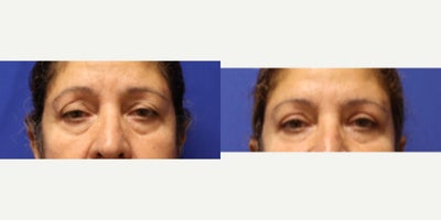 Eyelid Surgery before and after photo