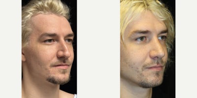 Septoplasty before and after photo
