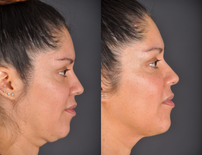 Thermage before and after photo