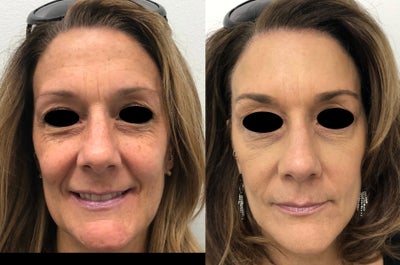 IPL before and after photo
