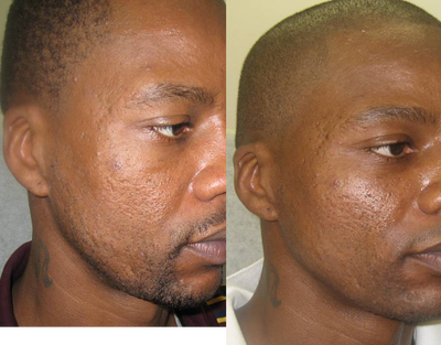 Laser Resurfacing before and after photo