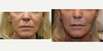 Radiesse before and after photo