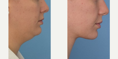Chin Liposuction before and after photo