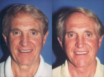 Facelift before and after photo